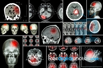 Set , Collection Of Brain Disease ( Cerebral Infarction , Hemorrhagic Stroke , Brain Tumor , Disc Herniation With Spinal Cord Compression ,etc)( Ct Scan , Mri , Mrt )( Neurology And Nervous System ) Stock Photo