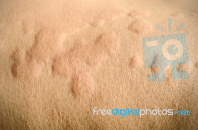 Skin Rash, Urticaria, Allergic Skin Reaction Stock Photo
