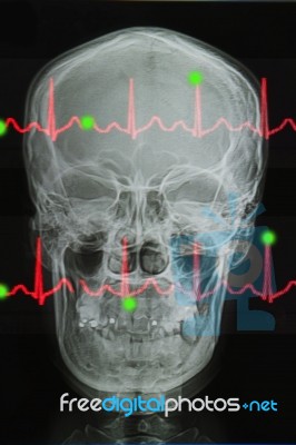 Skull X-rays Image And Lifeline Of Electrocardiogram Stock Photo