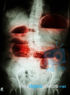 Small Bowel Obstruction Stock Photo