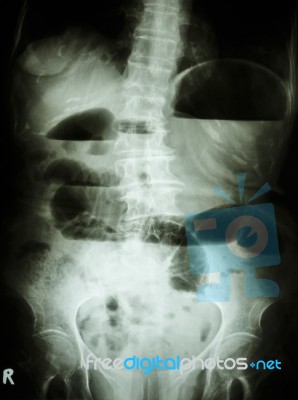 Small Bowel Obstruction Stock Photo