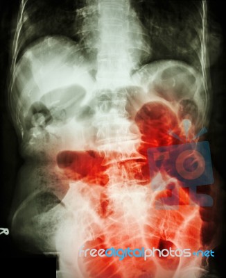 Small Bowel Obstruction.  Film X-ray Abdomen Supine :  Show Small Bowel Dilated Due To Small Bowel Obstruction Stock Photo