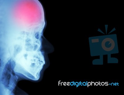 Stroke ( Cerebrovascular Accident ) ( Film X-ray Skull Lateral With Stroke ) And Blank Area At Right Side ( Medical And Science And Healthcare Background ) Stock Photo