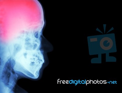 Stroke ( Cerebrovascular Accident ) ( Film X-ray Skull Lateral With Stroke ) And Blank Area At Right Side ( Medical And Science And Healthcare Background ) Stock Photo