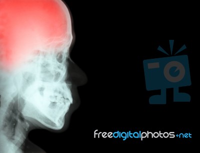 Stroke ( Cerebrovascular Accident ) ( Film X-ray Skull Lateral With Stroke ) And Blank Area At Right Side ( Medical And Science And Healthcare Background ) Stock Photo