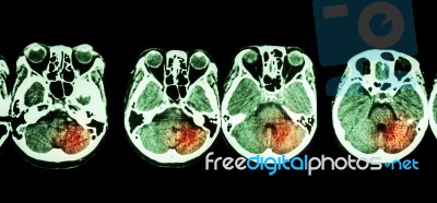 Stroke  ( Ct Scan Of Brain And Base Of Skull And Stroke ) Stock Photo