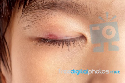 Stye Eye Infection Stock Photo