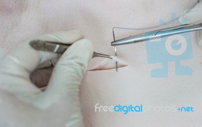 Suture Skin Stock Photo