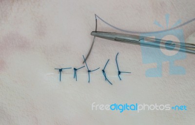 Suture Skin Stock Photo