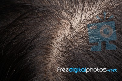 Thinning Hair And Scalp Stock Photo