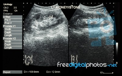 Ultrasonography Of Kidney : Show Left Kidney Stone ( 2 Image For Compare ) Stock Photo