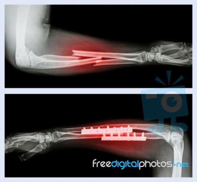 Upper Image : Fracture Ulnar And Radius (forearm Bone) , Lower Image : It Was Operated And Internal Fixed With Plate And Screw Stock Photo