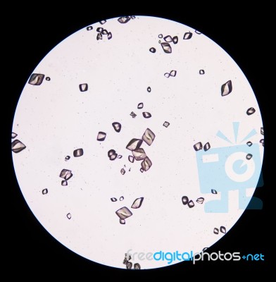 Uric Acid Crystal In Urine Sediment Stock Photo
