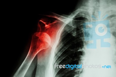X-ray Anterior Shoulder Dislocation Stock Photo