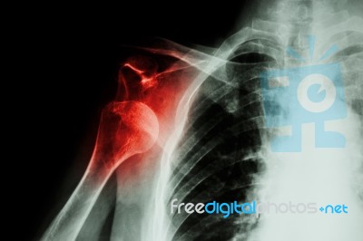 X-ray Anterior Shoulder Dislocation Stock Photo