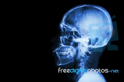 X-ray Asian Skull And Blank Area At Left Side Stock Photo