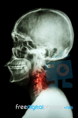 X-ray Asian Skull And Cervical Spine And Neck Pain Stock Photo