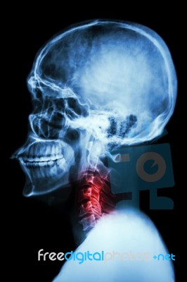 X-ray Asian Skull And Cervical Spine And Neck Pain Stock Photo