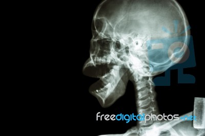 X-ray Asian Skull And Open Mouth Stock Photo