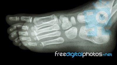 X-ray Foot Lateral : Show Normal Child's Foot Stock Photo