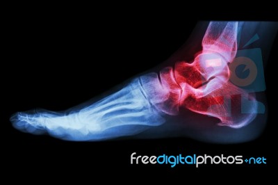 X-ray Human's Ankle With Arthritis Stock Photo