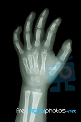 X-ray Infant's Hand Stock Photo