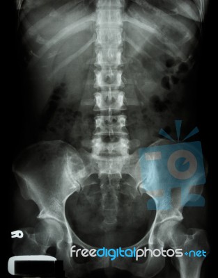 X-ray Lumbo-sacral Spine And Pelvis Of Asian Adult People Stock Photo