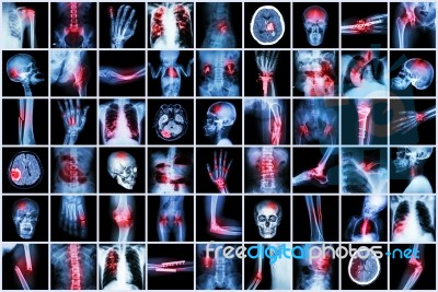 X-ray Multiple Disease Of Child And Adult ( Stroke , Arthritis , Fracture , Tuberculosis , Brain Tumor , Bowel Obstruction  , Kidney Stone , Spondylosis , Spondylolisthesis , Osteoarthritis Knee ,etc) Stock Photo