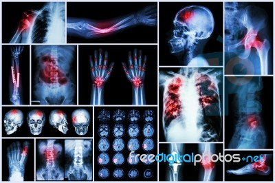 X-ray Multiple Disease (stroke (cerebrovascular Accident) : Cva ,pulmonary Tuberculosis ,bone Fracture ,shoulder Dislocation ,gout ,rheumatoid Arthritis ,spondylosis ,osteoarthritis ,bowel Obstruction Stock Photo