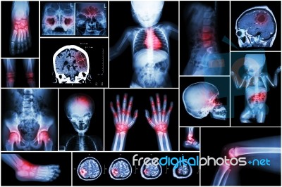 X-ray Multiple Part Of Child 's Body & Multiple Disease ( Stroke , Brain Tumor , Rheumatoid Arthritis , Sinusitis , Gouty Arthritis , Etc)( Skull Chest Lung Heart Spine Arm Hand Pelvis Leg Knee Foot ) Stock Photo