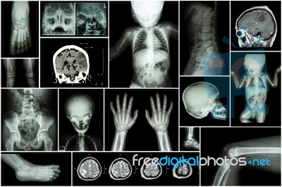 X-ray Multiple Part Of Child 's Body & Multiple Disease ( Stroke , Brain Tumor , Rheumatoid Arthritis , Sinusitis , Gouty Arthritis , Etc)( Skull Chest Lung Heart Spine Arm Hand Pelvis Leg Knee Foot ) Stock Photo