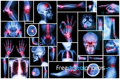 X-ray Multiple Part Of Human With Multiple Disease (stroke, Arthritis, Gout, Rheumatoid, Brain Tumor, Osteoarthritis, Etc) Stock Photo
