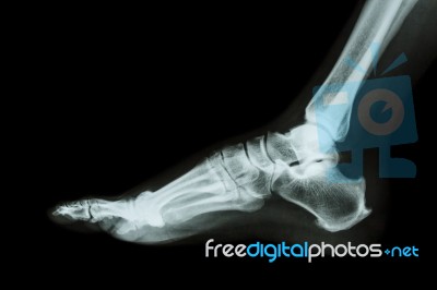 X-ray Normal Foot Lateral Stock Photo
