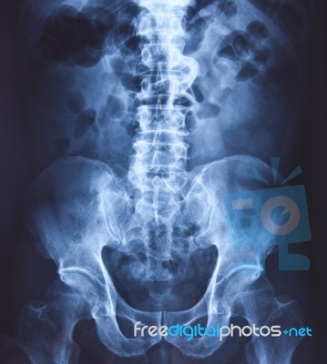 X-ray Pelvis And Spinal Column Stock Photo