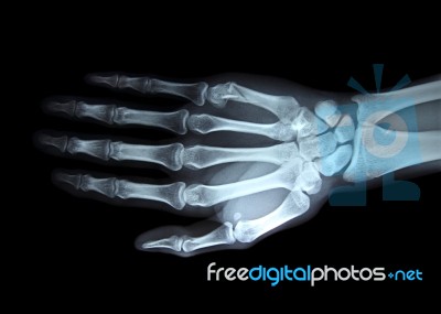 X-ray Right Hand Stock Photo