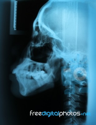 X-ray Skull Stock Photo