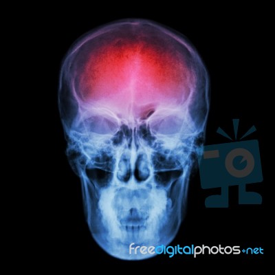 X-ray Skull And Stroke ( Cerebrovascular Accident (cva) ) Stock Photo