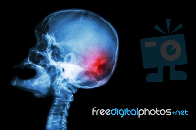 X-ray Skull Open Mouth ( Side View ) And Stroke ( Cerebrovascular Accident ( Cva ) ) And Blank Area At Right Side Stock Photo