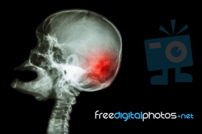 X-ray Skull Open Mouth ( Side View ) And Stroke ( Cerebrovascular Accident ( Cva ) ) And Blank Area At Right Side Stock Photo