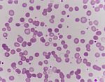 Abnormal Red Blood Cells Stock Photo