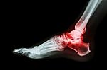 Arthritis At Ankle Joint (gout , Rheumatoid Arthritis) Stock Photo