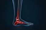Arthritis Of Ankle. X-ray Of Foot. Lateral View Stock Photo