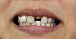 Bad Teeth Stock Photo