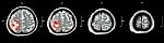 Brain Tumor  ( Film Ct-scan Of Brain : Show Part Of Brain With Tumor ) Stock Photo