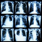 Collection Of Lung Disease (pulmonary Tuberculosis,pleural Effusion,bronchiectasis) Stock Photo