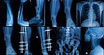 Collection Of  X-ray , Multiple Part Of Adult  Show Fracture Bone And  Disease Stock Photo