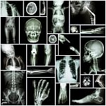 Collection X-ray "multiple Part Of Human" ,"orthopedic Surgery" And "multiple Disease" (fracture,shoulder Dislocation,osteoarthritis Knee,bronchiectasis,lung Disease,stroke,brain Tumor, Etc) Stock Photo