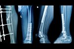 Collection X-rays Image Of  Fracture Lower Extremity Stock Photo
