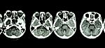 Ct Scan Of Brain And Base Of Skull ( Show Structure Of Eye , Ethmoid Sinus , Cerebellum , Cerebrum, Etc ) Stock Photo