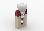 Dental Implantation Stock Photo